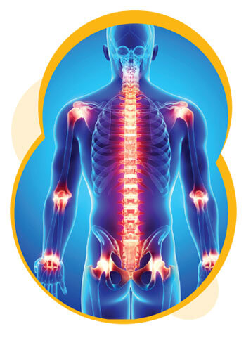 Squelette avec inflammation visible dans l'articulation et la colonne vertébrale